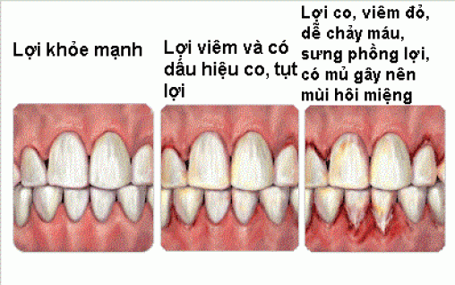 Chảy máu chân răng