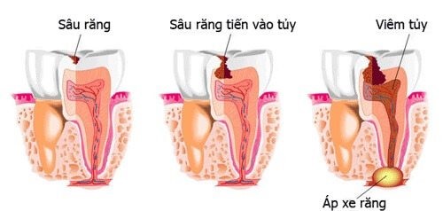 Chảy máu chân răng