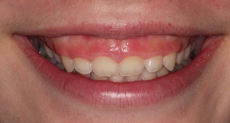 gummy-smile-drhung-dental